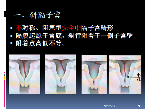 子宫弯曲是什么原因引起的