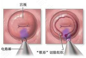 宫颈口内发红是怎么回事 宫颈口内发红是怎么回事