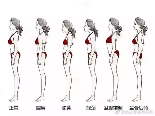 如何判断自己是否骨盆前倾 如何判断自己是否骨盆前倾