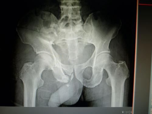 骨盆粉碎性骨折能好吗 骨盆粉碎性骨折能好吗