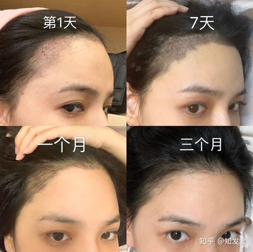 前额头发稀少怎么办 前额头发稀少怎么办