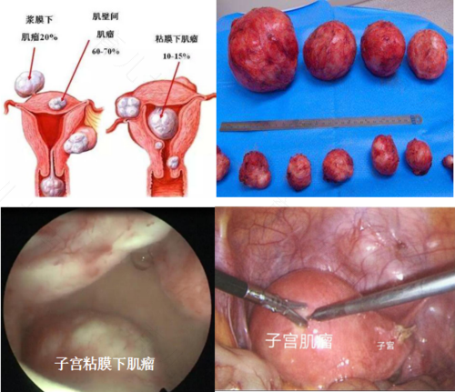 浆膜下子宫肌瘤必须得手术吗 浆膜下子宫肌瘤必须得手术吗