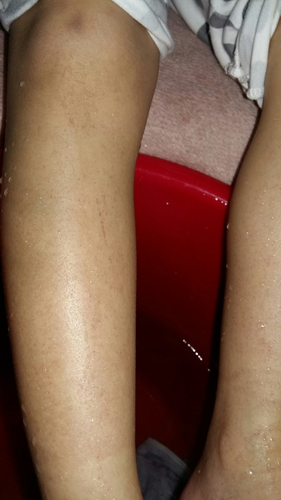 白血病出血点是什么样的