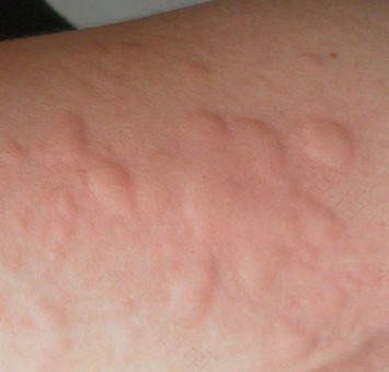 荨麻疹的症状和治疗方法 荨麻疹的症状和治疗方法