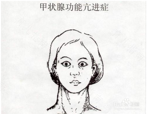 得了甲亢会掉头发吗 得了甲亢会掉头发吗