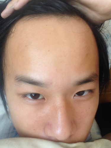 额头没有头发怎么办