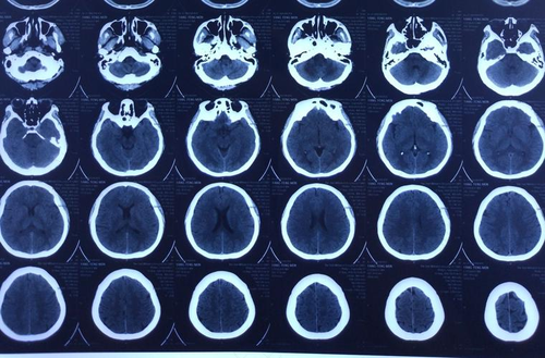 经常左边头麻是怎么回事呢 经常左边头麻是怎么回事呢