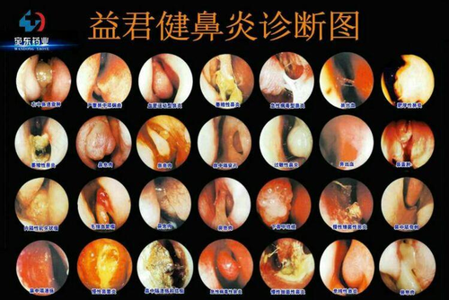 鼻炎是什么样的症状 鼻炎是什么样的症状