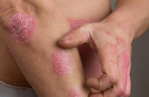 花斑癣不治自己会好吗 花斑癣不治自己会好吗