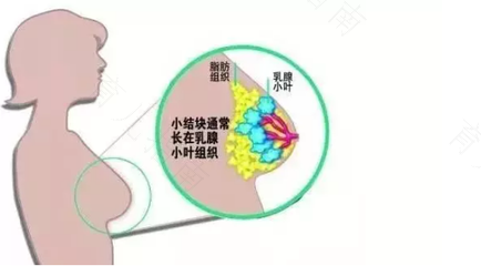 乳房囊肿怎么引起的吗 乳房囊肿怎么引起的吗