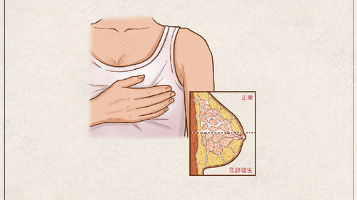 女生有乳腺增生正常吗 女生有乳腺增生正常吗