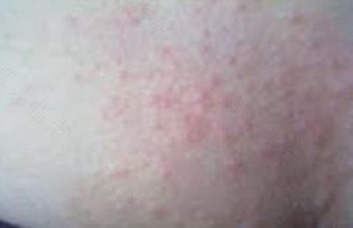 换季过敏皮肤痒长包怎么办 换季过敏皮肤痒长包怎么办