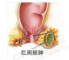 肛门囊肿怎么解决 肛门囊肿怎么解决