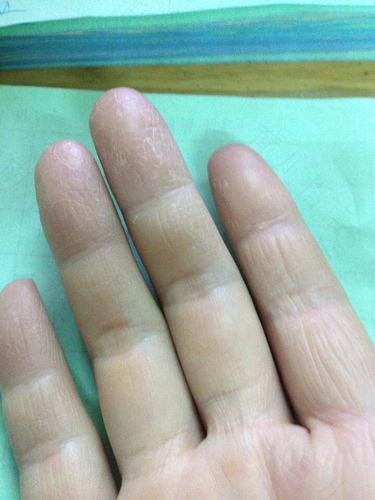 手掌手指干裂脱皮怎么办 手掌手指干裂脱皮怎么办
