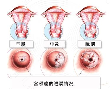 子宫息肉会有什么影响吗