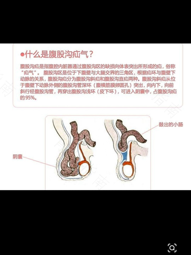 附睾肿痛怎么办 附睾肿痛怎么办