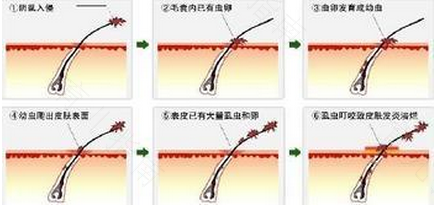 怎么彻底治疗阴虱 怎么彻底治疗阴虱