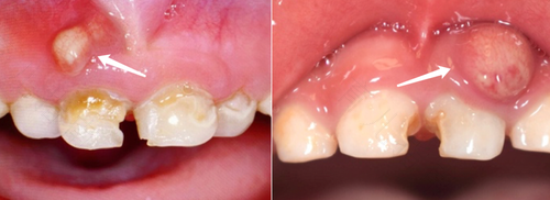 小孩牙龈肿了个包怎么办 小孩牙龈肿了个包怎么办