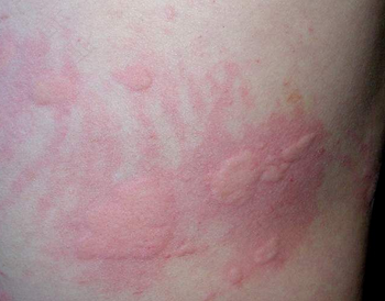 荨麻疹能打什么针治疗效果最好 荨麻疹能打什么针治疗效果最好