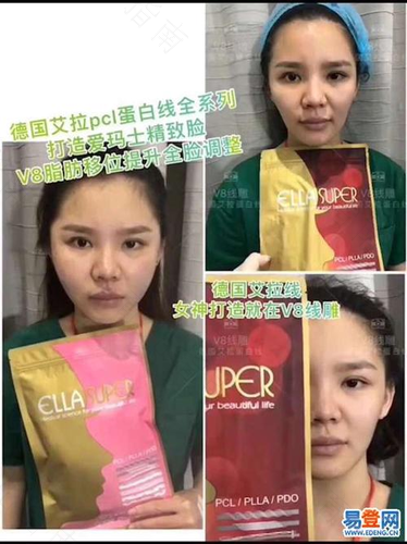 做线雕鼻子有什么副作用