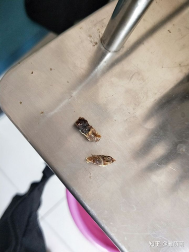 大块耳屎掏不出来怎么办 大块耳屎掏不出来怎么办