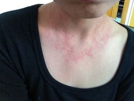 突然起风疹怎么办 突然起风疹怎么办