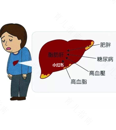 脂肪肝如何治疗效果好 脂肪肝如何治疗效果好