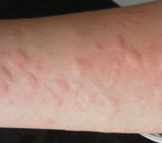 儿童寻麻疹发烧怎么办? 儿童寻麻疹发烧怎么办?