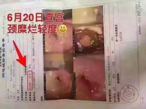 宫颈糜烂不手术能治好吗 宫颈糜烂不手术能治好吗