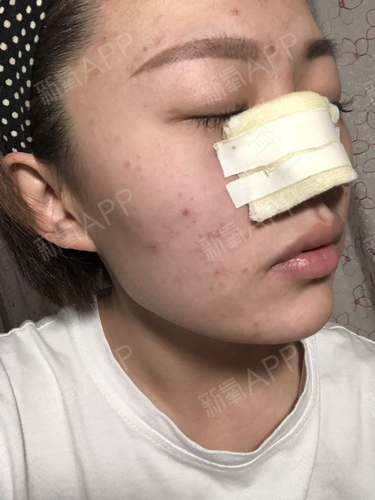 鼻子里面酸胀是怎么回事 鼻子里面酸胀是怎么回事