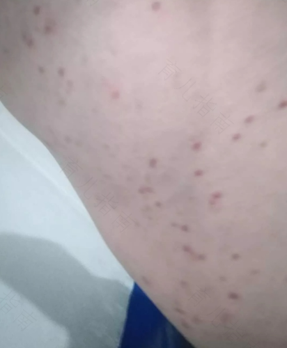 艾滋病红点几天会消失 大腿