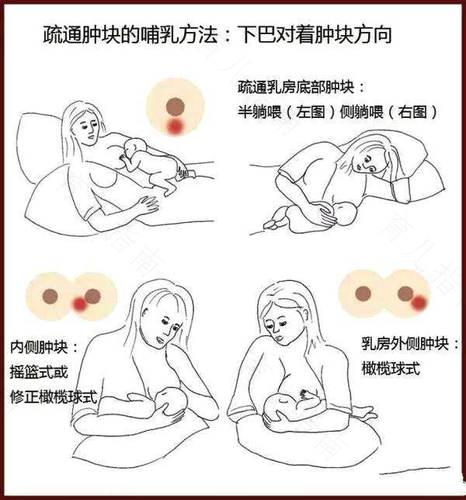 奶被堵了是什么症状 奶被堵了是什么症状