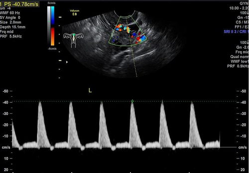 中医改善子宫动脉血流 中医改善子宫动脉血流