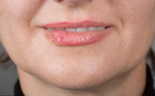 嘴唇上起小泡泡怎么回事 嘴唇上起小泡泡怎么回事