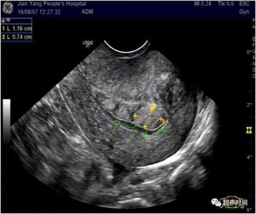 子宫内膜息肉超声表现为哪些 子宫内膜息肉超声表现为哪些