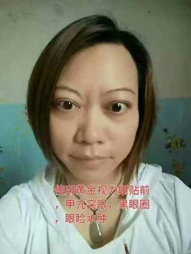 甲亢为什么会突眼? 甲亢为什么会突眼?