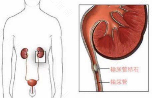 输尿管结石疼痛怎么办 输尿管结石疼痛怎么办