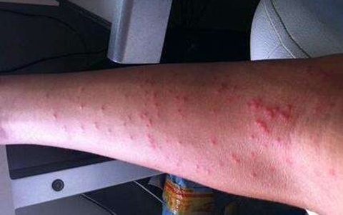 荨麻疹怎么治疗能除根 荨麻疹怎么治疗能除根