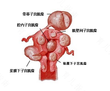 子宫肌瘤都有什么症状