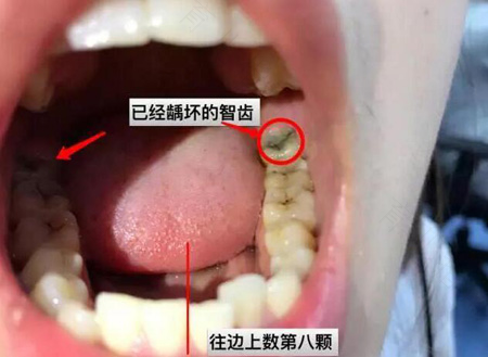两边磨牙都坏掉了怎么办 两边磨牙都坏掉了怎么办