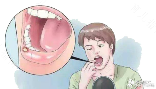 严重口腔溃疡怎么办? 严重口腔溃疡怎么办?