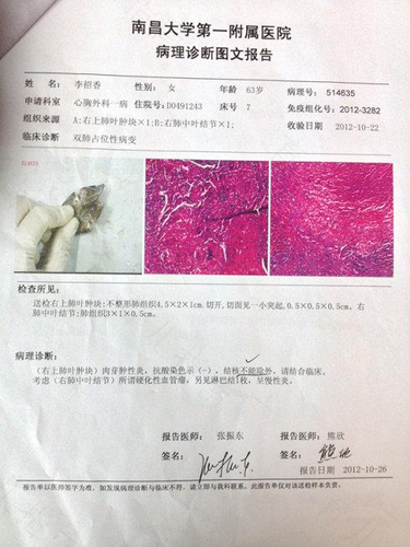 肺部活检是不是确定就是癌 肺部活检是不是确定就是癌