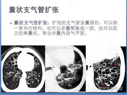 早期支气管扩张能治愈吗