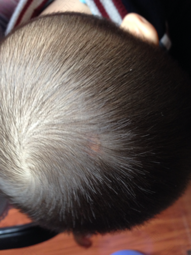 宝宝头上磕碰了留疤怎么办 宝宝头上磕碰了留疤怎么办