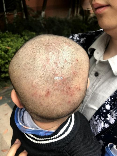 湿疹多出汗好吗 湿疹多出汗好吗