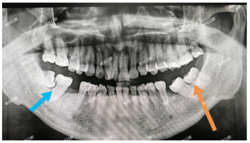 拔牙后多长时间镶牙最好 拔牙后多长时间镶牙最好