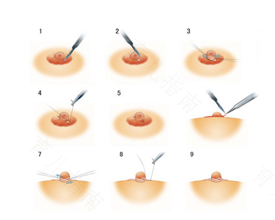 乳头内陷不治疗有问题吗 乳头内陷不治疗有问题吗