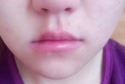 年轻人突然嘴歪流眼泪是怎么回事 年轻人突然嘴歪流眼泪是怎么回事