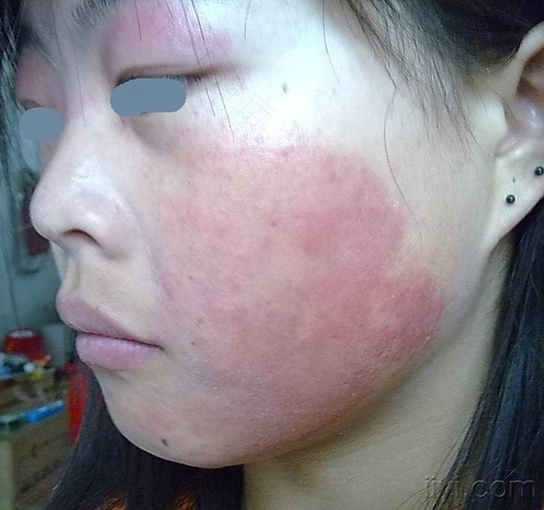 遗传湿疹可以治疗吗 遗传湿疹可以治疗吗