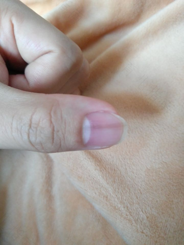 指甲里面有黑块是怎么回事 指甲里面有黑块是怎么回事